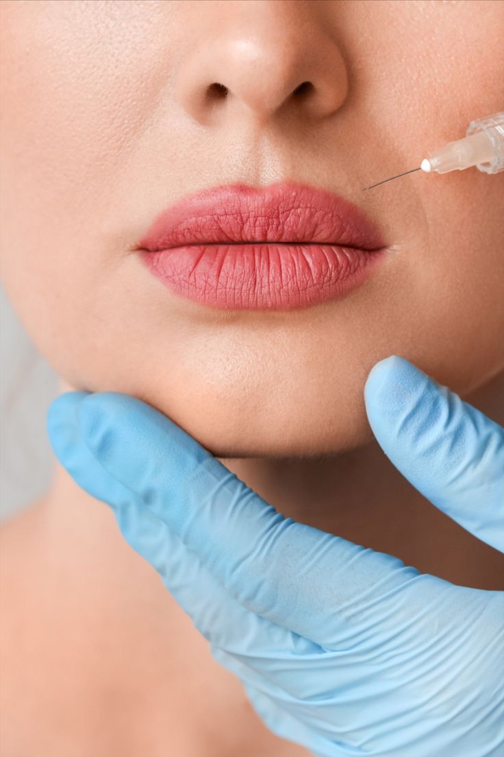 Preenchimento Labial